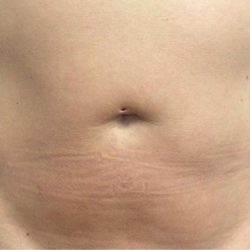 TruSculpt ID Before & After Patient #1566